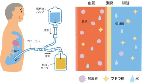 透析法